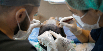 Hair Transplant in London