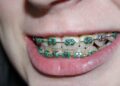 How Dental Braces Improve Oral Health and Alignment