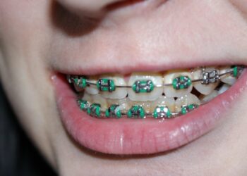 How Dental Braces Improve Oral Health and Alignment