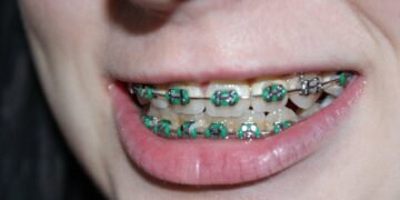 How Dental Braces Improve Oral Health and Alignment