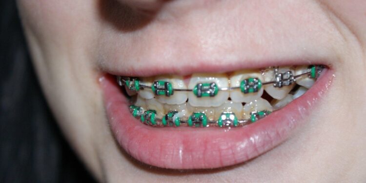 How Dental Braces Improve Oral Health and Alignment