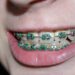 How Dental Braces Improve Oral Health and Alignment