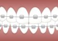 Top Benefits of Getting Dental Braces for Teens and Adults
