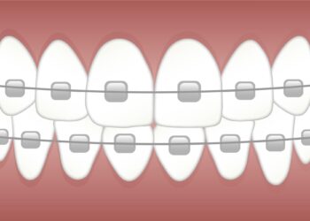 Top Benefits of Getting Dental Braces for Teens and Adults